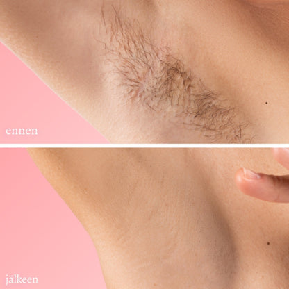 SilkaPoisto – hellävarainen karvanpoisto ilman kipua